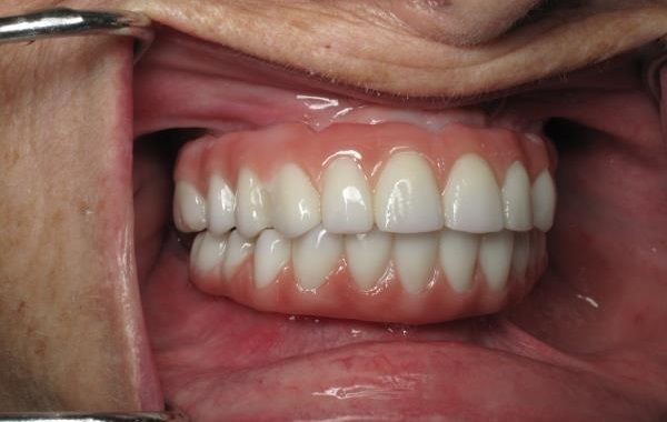 Aspen Dental Comfilytes Dentures Harleysville PA 19438